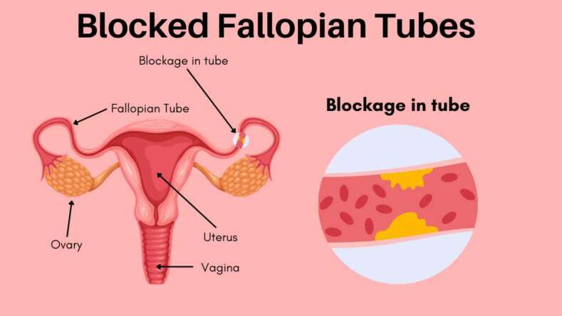 7 Steps to Getting Pregnant With Blocked Fallopian Tubes | Fertile Tree