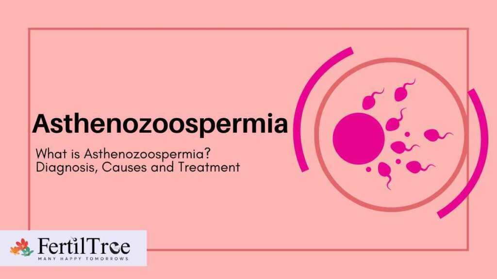 Asthenozoospermia diagnosis and treatment