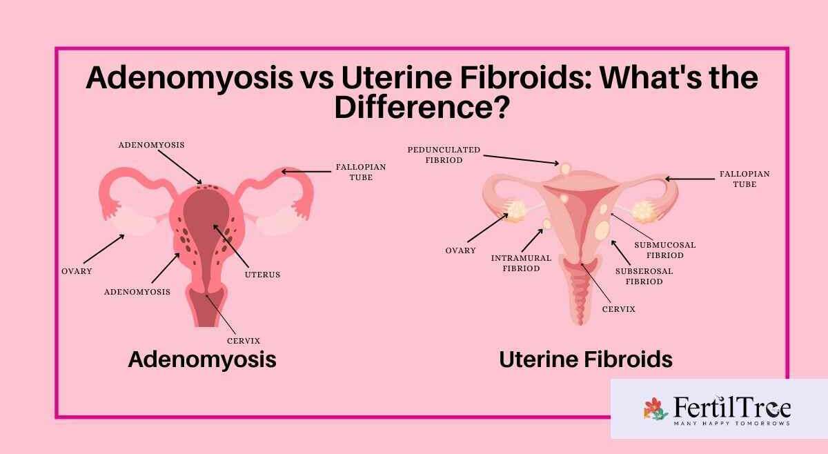 adenomyosis vs uterine