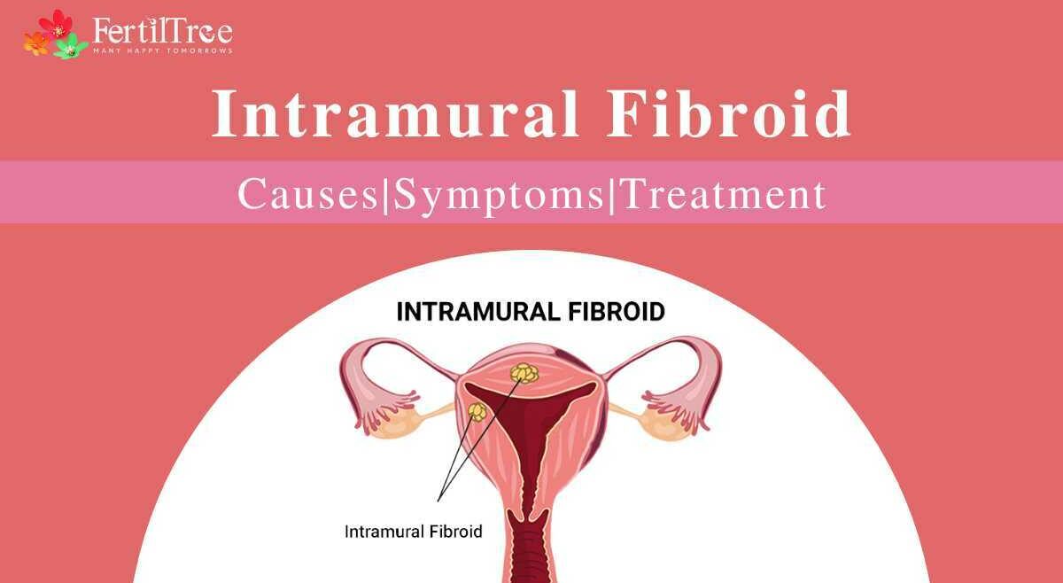Symptoms, causes and treatment of Intramural Fibroid